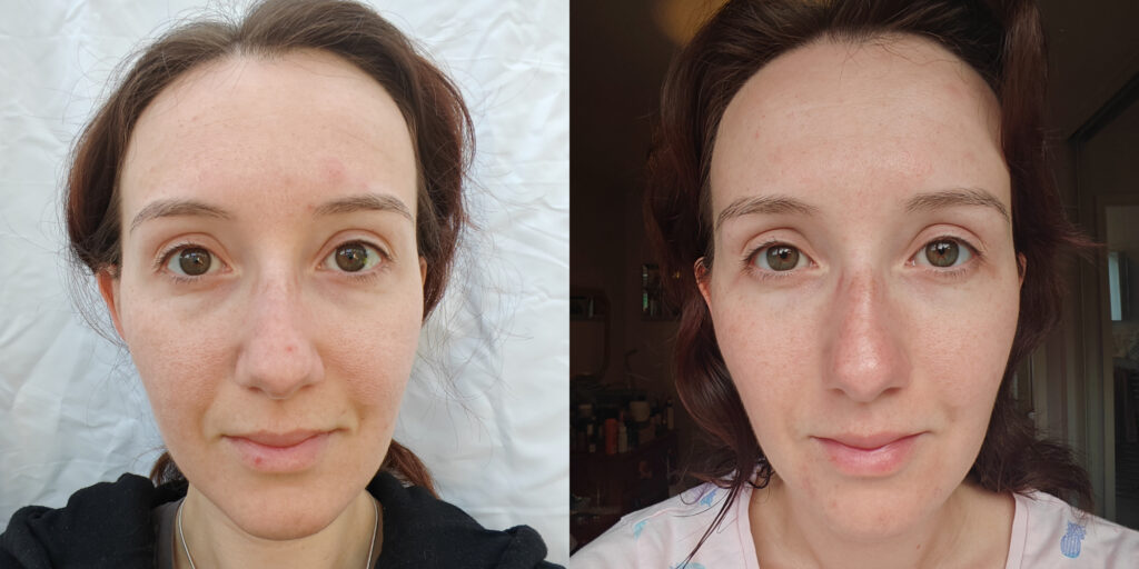 Two side-by-side photos showing a woman's face before and after Lustre Renew Pro Facewear LED Light Therapy treatment, with visible improvements.