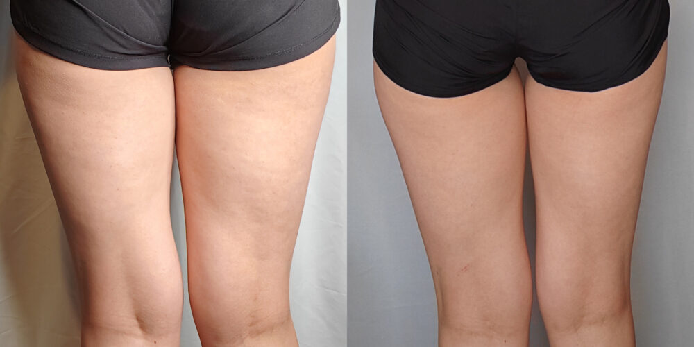 [AD] Introducing The Feel Smooth Skin Supplement [First Anti-Cellulite ...